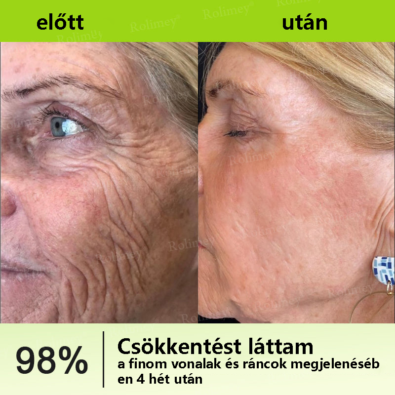 💫🪄🌟Magyarországon készült, közvetlenül Magyarországról szállítjuk 💫Rolimey® Botox és Retinol Szérum – Emeli és feszesíti a bőrt, csökkenti a ráncokat – Az akció utolsó napja, 70% KEDVEZMÉNY az egész üzletben
