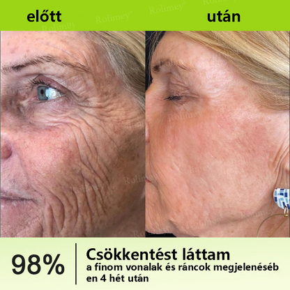 💫🪄🌟Magyarországon készült, közvetlenül Magyarországról szállítjuk 💫Rolimey® Botox és Retinol Szérum – Emeli és feszesíti a bőrt, csökkenti a ráncokat – Az akció utolsó napja, 70% KEDVEZMÉNY az egész üzletben
