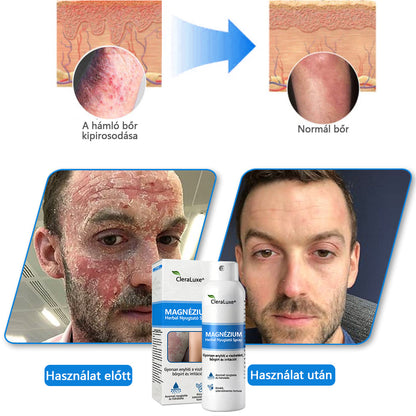 CleraNature® Magnéziumos Spray – Gyors Enyhülés Viszkető, Vörös és Érzékeny Bőrre (Még Intim Területeken is)