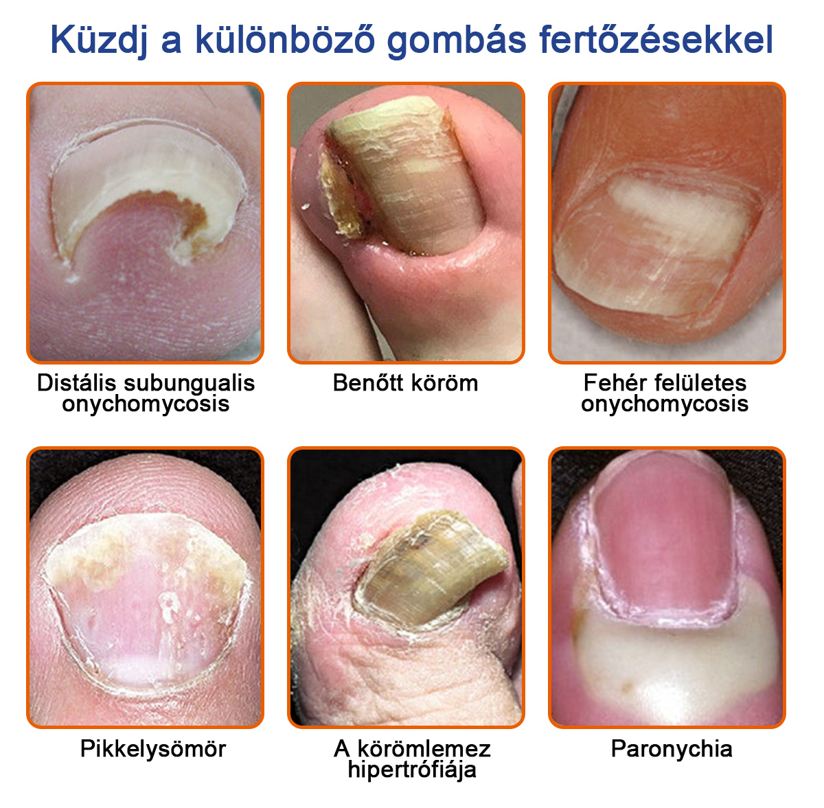 🐝Furzero™ Méhméreg Körömgomba Kezelőoldat: Teljes megoldás a körömgomba problémájára🌟👣👣（Az utánvétes fizetést）