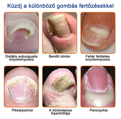 🐝Furzero™ Méhméreg Körömgomba Kezelőoldat: Teljes megoldás a körömgomba problémájára🌟👣👣（Az utánvétes fizetést）