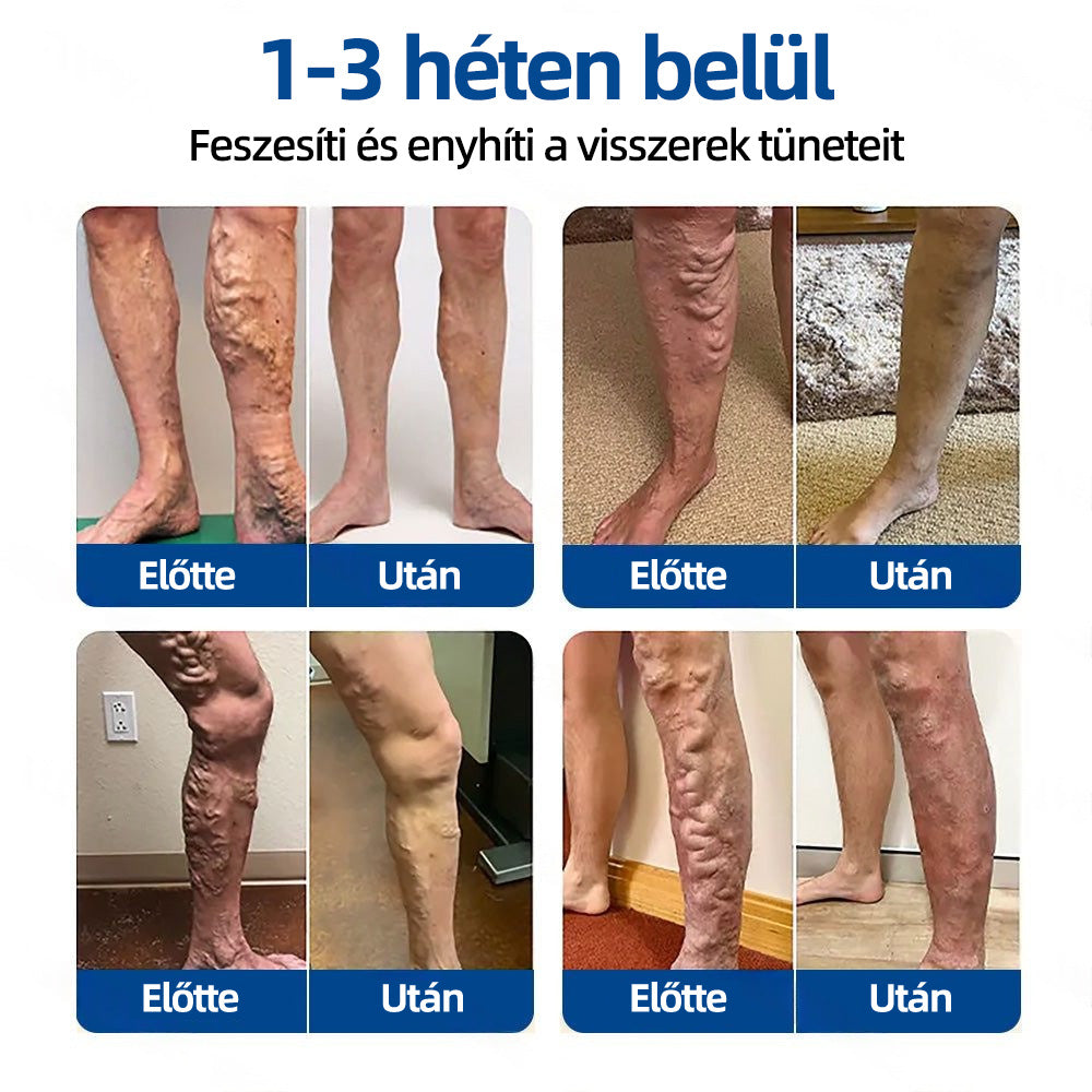 🌲Healrize® Vénacélpont mikrotűs tapasz⚡Azonnali enyhülés hosszú távú eredmények🇭🇺