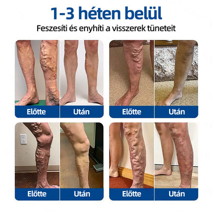 🌲Healrize® Vénacélpont mikrotűs tapasz⚡Azonnali enyhülés hosszú távú eredmények🇭🇺