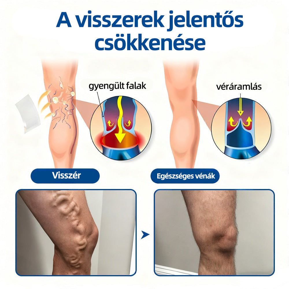 🌲Healrize® Vénacélpont mikrotűs tapasz⚡Azonnali enyhülés hosszú távú eredmények🇭🇺
