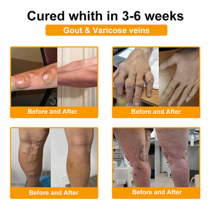 💎TLOPA® Botulinum Toxin és Méhméreg Fájdalomcsillapító Csontgyógyító Krém🐝 🔥(Kifejezetten időseknek & ortopéd szakorvosok ajánlásával)🦴